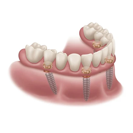 Fixed Dentures