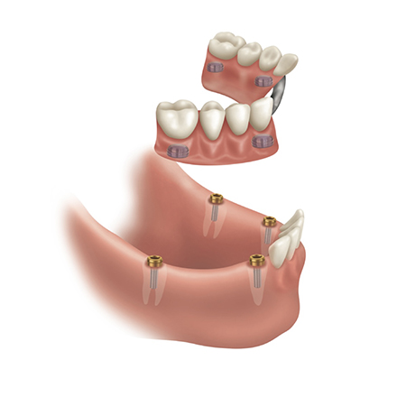 Implant RPD