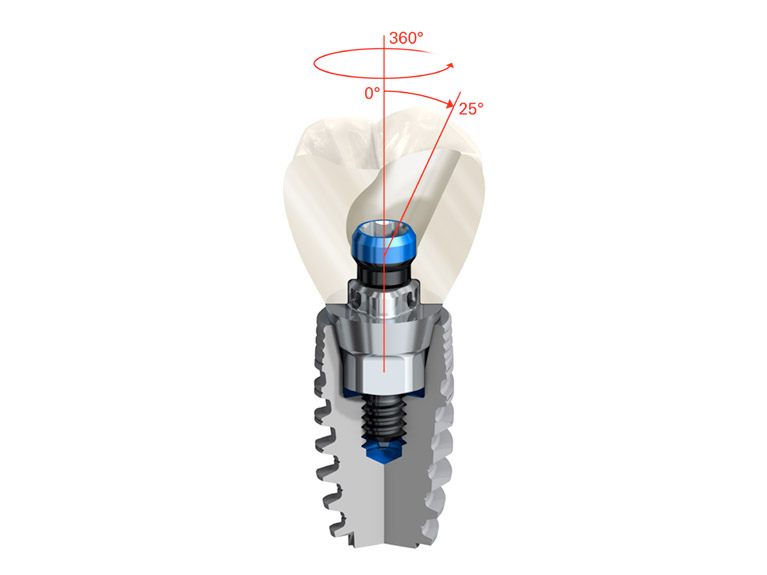 NobelProcera-FCZ-Implant-Crown