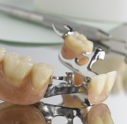 implant partial dentures
