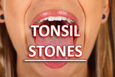 Gwinn dentist, Dr. Gwendolyn Buck at Northern Trails Dental Care tells patients about what causes tonsil stones and how to treat and prevent them from forming.