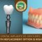 Dental Implants vs. Dentures: Which Tooth Replacement Option Is Right for You? (featured image)