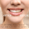 Everything You Want to Know About Teeth Whitening (featured image)